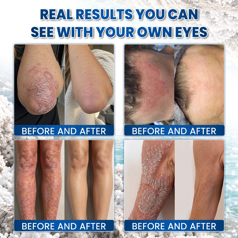 🌿🌿 Medistart® PSORIASIS SPECIALIZED SKIN CARE