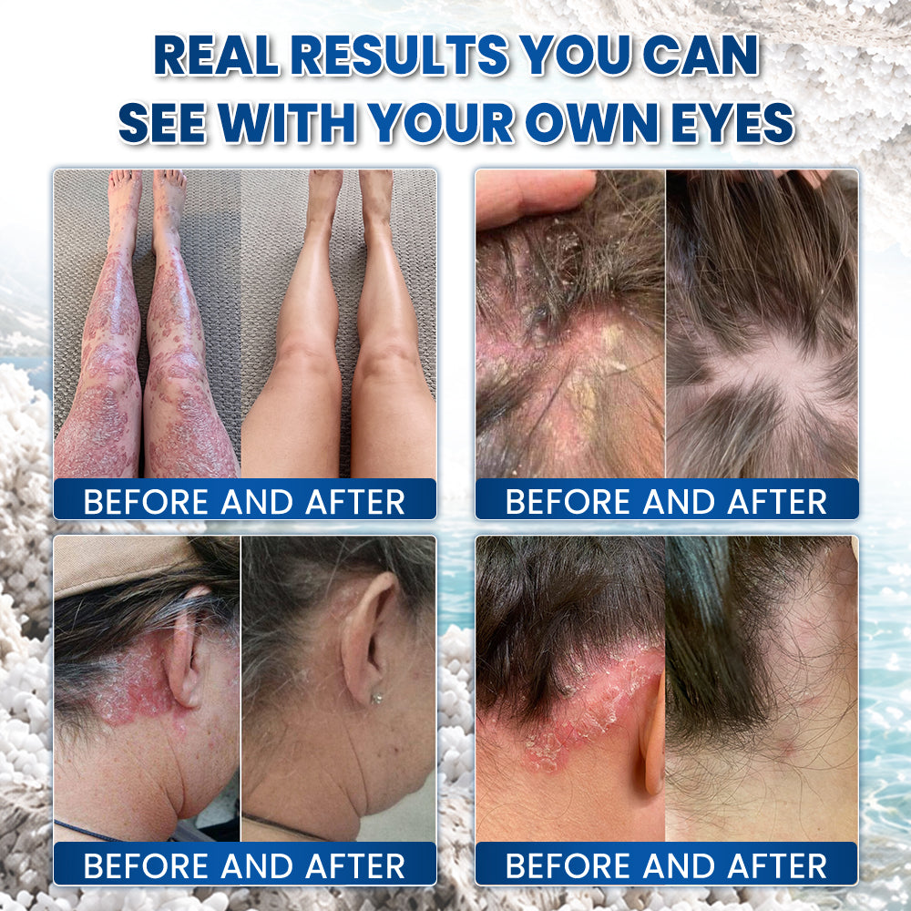 🌿🌿 Medistart® PSORIASIS SPECIALIZED SKIN CARE