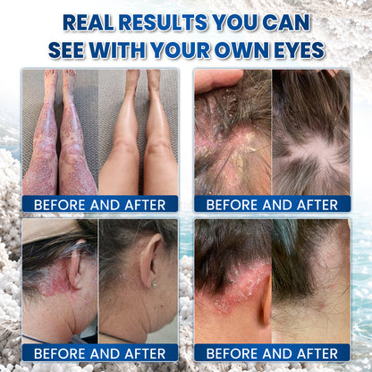 🌿🌿 Medistart® PSORIASIS SPECIALIZED SKIN CARE