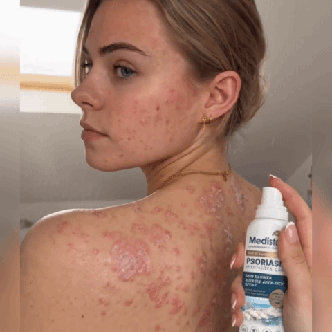 🌿🌿 Medistart® PSORIASIS SPECIALIZED SKIN CARE